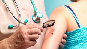 Melanoma, il primo vaccino personalizzato a mRNA riduce del 42% il rischio che il tumore ritorni