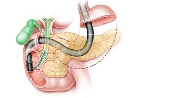 Pancreas malato? Interviene la tecnologia