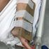 Cartone al posto del gesso a Reggio Calabria, i medici: 