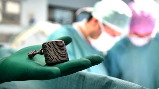 Tumori dell’osso, le protesi si stampano in 3D