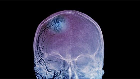 Classificare i tumori? Ci pensa l'intelligenza artificiale