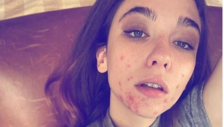 Matilda De Angelis tra Hugh Grant e i brufoli, la giovane star svela l'acne: "Guardate come vado sul set"