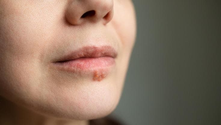 Perché è difficile sviluppare un vaccino efficace e sicuro contro l’Herpes simplex?