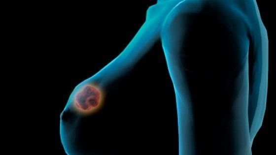 Ribociclib, il sì dell’Europa a una nuova terapia per il tumore al seno avanzato 