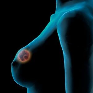Tumore del seno: l’80% delle pazienti è vivo a 10 anni dalla diagnosi, ma il 48% pensa che non si possa guarire 