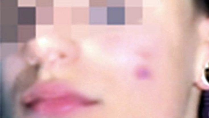 Cicatrice francese, anche in Puglia allarme per la sfida social: "Prof e genitori, massima attenzione"