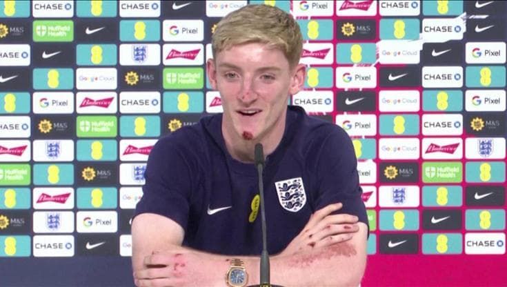 Euro 2024,  incidente in bici per il giocatore dell'Inghilterra Gordon: "Escoriazioni e lividi, niente di grave. Colpa del telefonino"