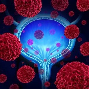 Tumore rene, speranze dai farmaci immuno-terapici e bersaglio molecolare 