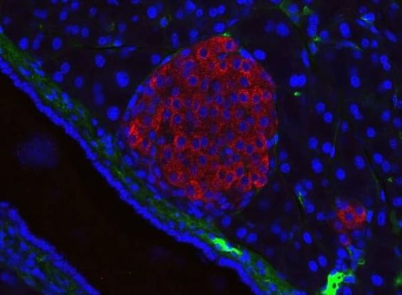 Test delle urine apre una speranza per la diagnosi precoce del tumore al pancreas