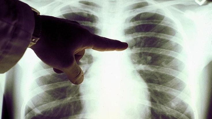 Possiamo evitare quattro tumori su dieci: ecco i trenta nemici da cui stare alla larga
