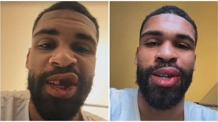 Loftus-Cheek operato posta foto con e senza denti