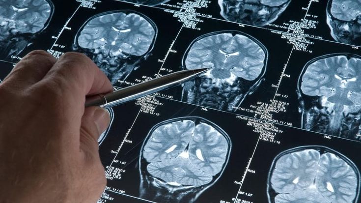 Alzheimer, dai ricercatori italiani nuove tecniche di neuroimaging per diagnosi precoci