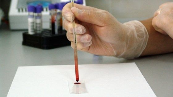 Leucemia, guarisce un giovane che non rispondeva alle cure