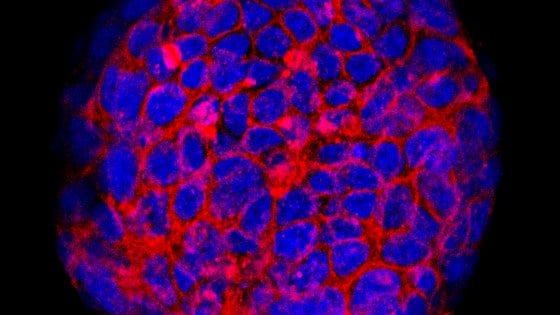 Il tumore raro della prostata si studia con un modello in 3D