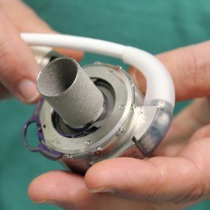 Impiantato cuore magnetico provvisorio per la prima volta su paziende pediatrico