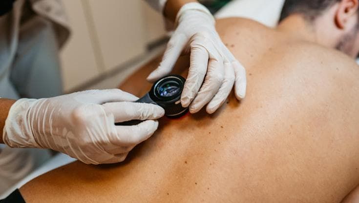 Vaccino per il melanoma a mRNA, positivi i risultati. E Merck e Moderna volano in borsa