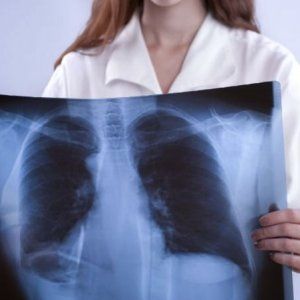 Ricerca, due nuovi farmaci per combattere il tumore al polmone