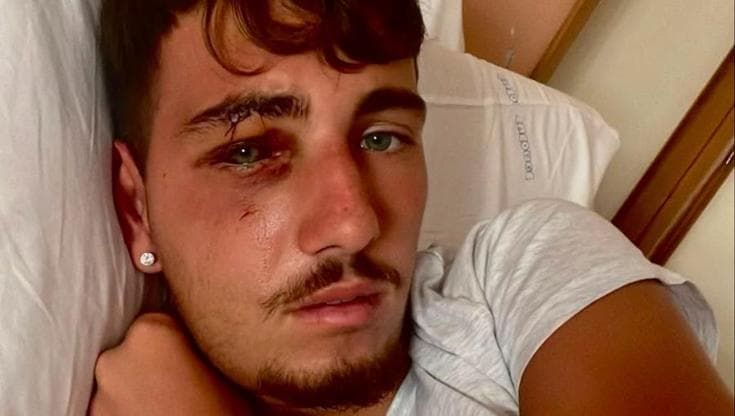 Due minorenni picchiarono a sangue un diciottenne a Mondello, uno va in comunità l’altro in carcere