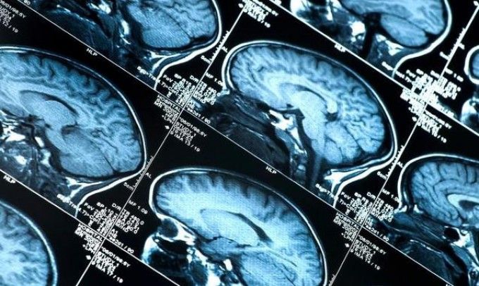 Ricerca, studio italiano individua l'origine dell'Alzeheimer