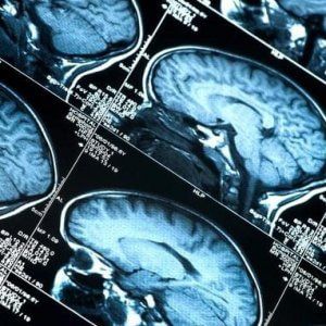 Ogni anno in Piemonte 14mila persone sono colpite da un ictus
