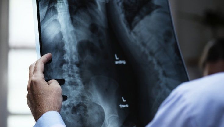 Tumore del polmone, la radioterapia non è per tutti