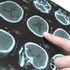 Parkinson, cellule cervello riprogrammate per combatterlo