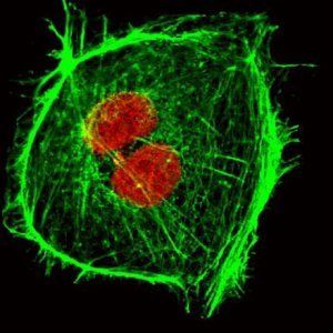 Scoperta proteina-vettore delle cellule tumorali: cancellarla evita estensione metastasi