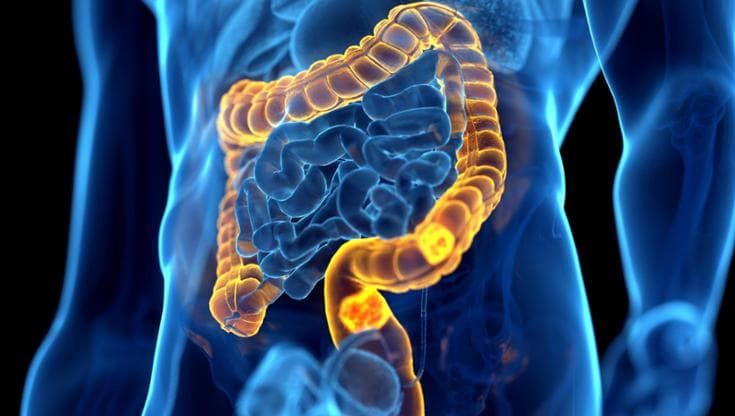 Tumore al colon-retto, quanto sono efficaci gli screening?