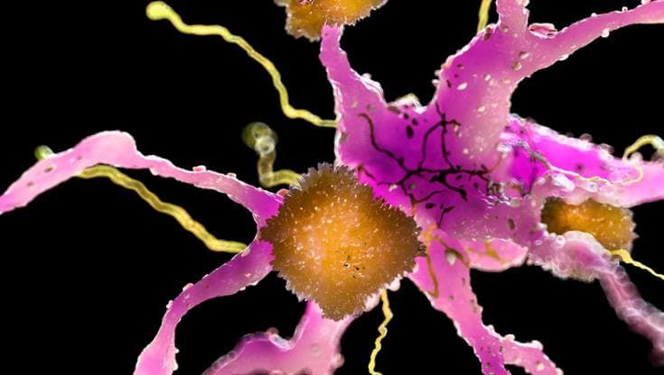 Alzheimer, così la stimolazione elettrica può ostacolare le placche di amiloide