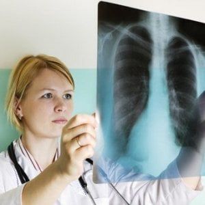  Tumore polmone, parere Ue favorevole per l’immunoterapia che può sostituire la chemio