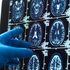 Alzheimer, scoperto il meccanismo che regola la perdita delle sinapsi