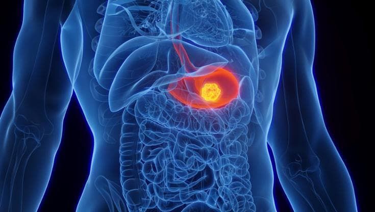 Tumore allo stomaco e all’esofago: nuovi dati per l’utilizzo dell’immunoterapia