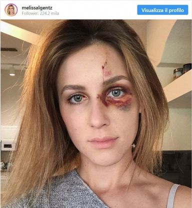 Campione di motocross picchia la fidanzata perché "troppo scollata". Lei lo denuncia su Instagram