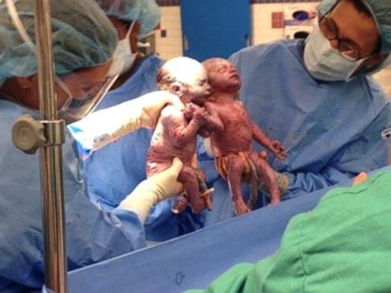Usa, inseparabili dopo il parto: le gemelline mano nella mano