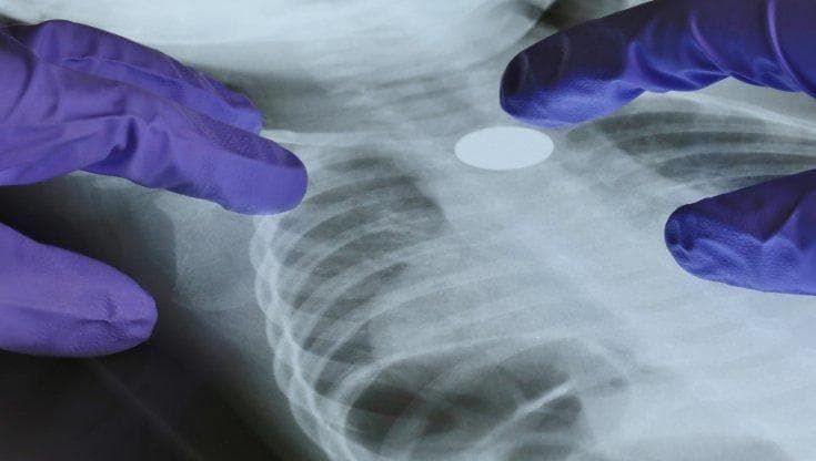 Tumore del polmone: il Dna ci dice se la terapia è utile