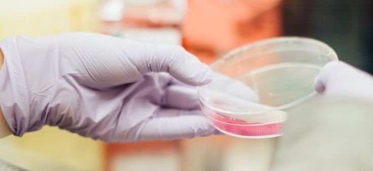 Tumore al seno triplo negativo: l’immunoterapia riduce il rischio di recidiva