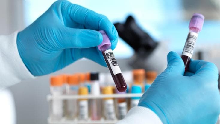 Un test del sangue potrebbe prevedere l’Alzheimer con dieci anni di anticipo