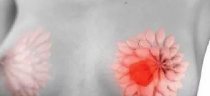 Tumore al seno, quando la chemio è necessaria