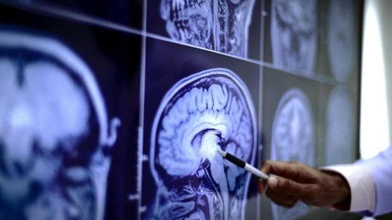 Micro-ictus silenti, il rischio sale se si eccede con alimenti ultraprocessati
