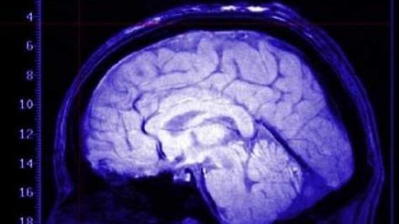 Glioma, individuati nuovi fattori genetici di rischio. I tumori cerebrali hanno meno segreti