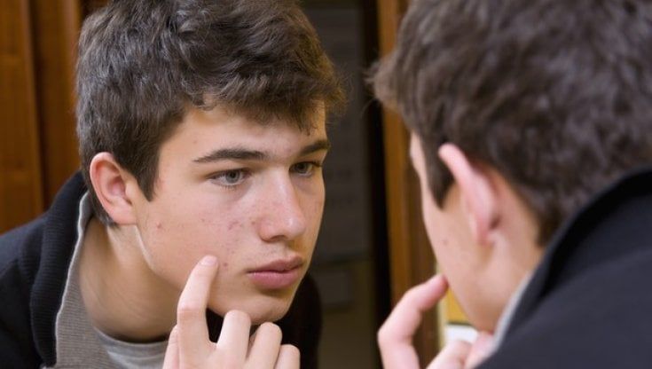 Acne, ecco come si può curare con la luce 