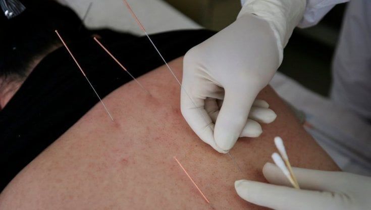 Agopuntura in ospedale, al via il censimento delle strutture dove si pratica