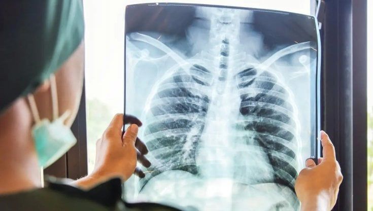 Covid, dalla radiografia alla scoperta della polmonite in un solo minuto grazie all'Intelligenza artificiale