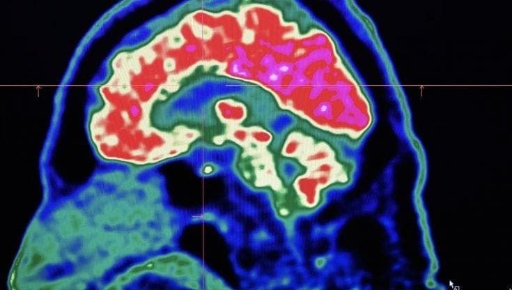 Linfoma, terapia Car-T più sicura grazie a Pet cerebrale