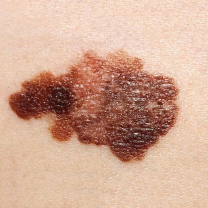 Melanoma: campanelli d'allarme e comportamenti da evitare 
