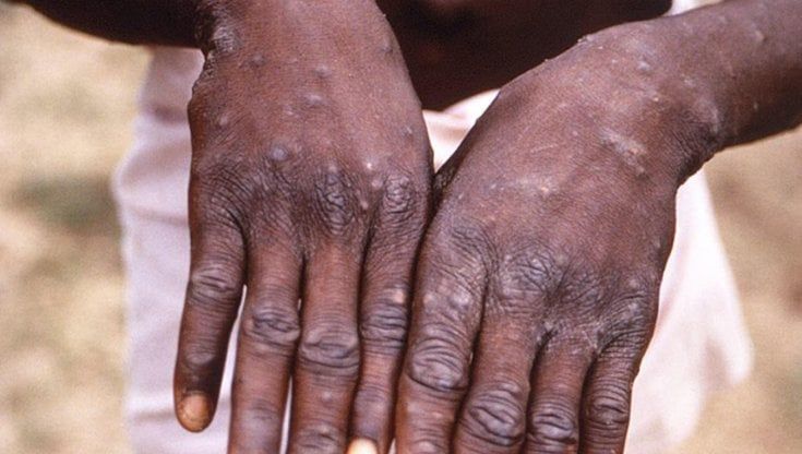 Vaiolo delle scimmie, al via oggi in Emilia-Romagna le prime vaccinazioni