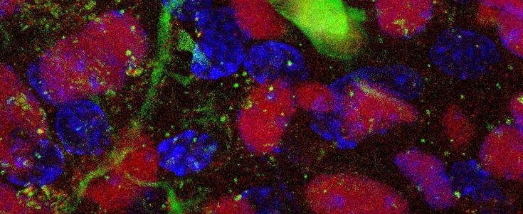 Dalle staminali speranza reale contro la Sla: bene la prima fase della sperimentazione