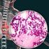 Adenocarcinoma polmonare, cos’è e come si cura il tumore che ha colpito il Papa
