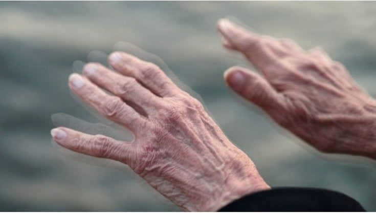 Parkinson, l'importanza della diagnosi precoce e delle nuove terapie a ultrasuoni