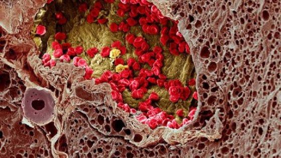 Mappare il cancro con un algoritmo 